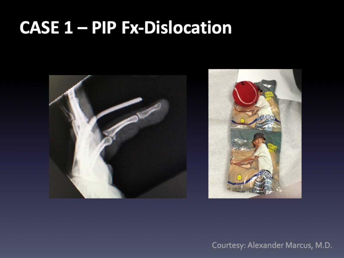 PIP Fracture Dislocation Archives - Virak Orthopedics