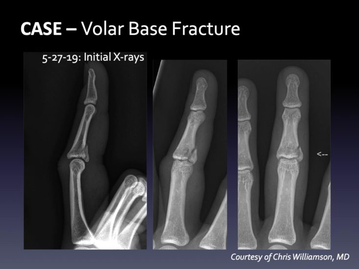 PIP Fracture Dislocation Archives - Virak Orthopedics