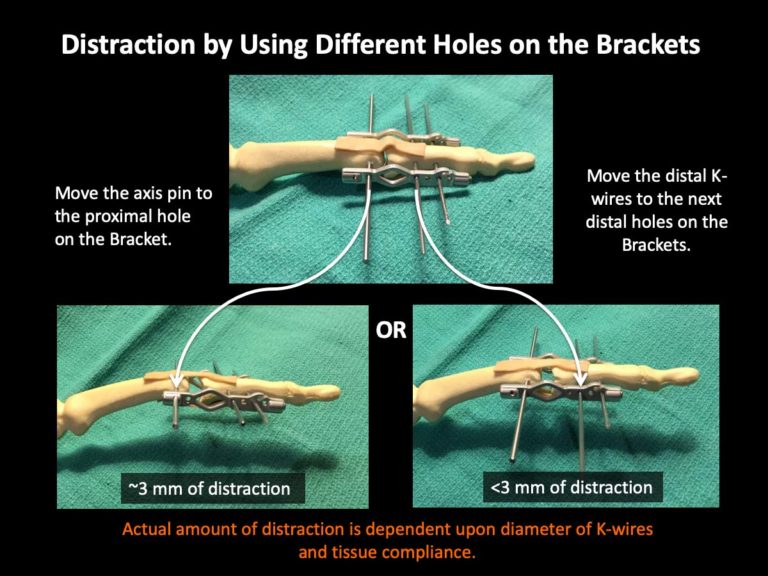 Distraction Methods Archives - Virak Orthopedics